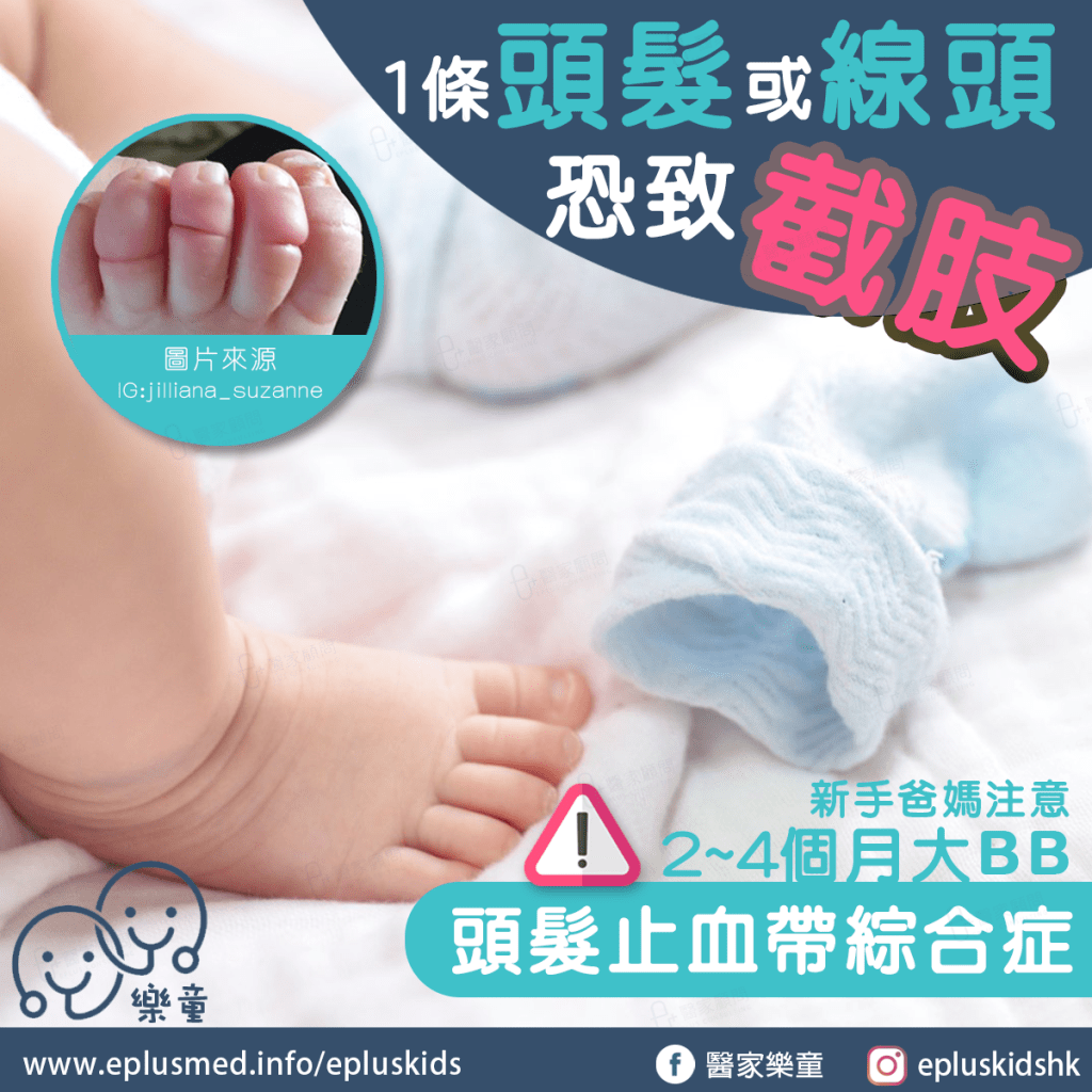 Epluskids_fb cover_頭髮止血帶綜合症