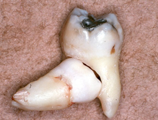 Eplusmed blog_dr Sam Ng_wisdom teeth_pic 1