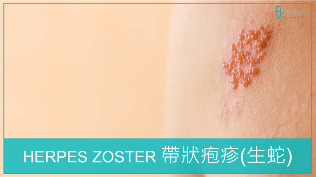 Medinfo cover 2024_Zoster_生蛇